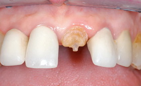 восстановление коронок зубов